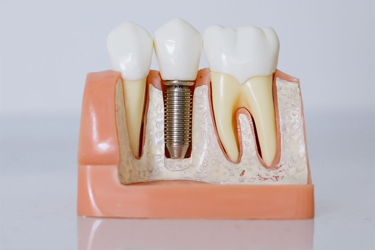 Dental implants in Bhagalpur