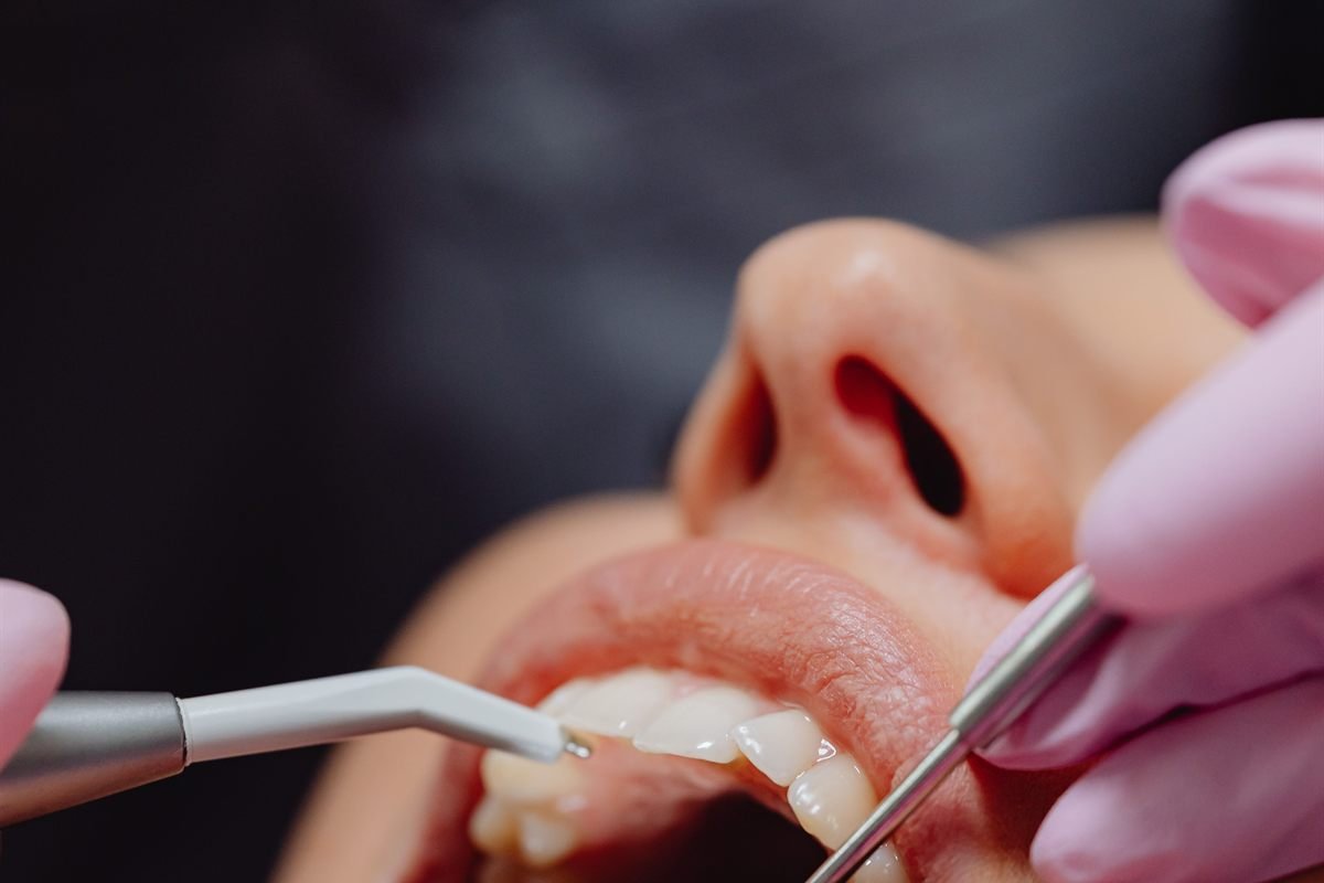 Periodontal Treatments at Khushi Dental Care